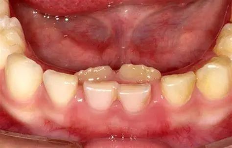 国际癌症研究机构|食不厌精，脍不厌细：伙食真的越精细越好吗？