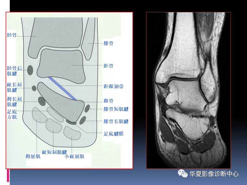 踝關節mri解剖與常見病變