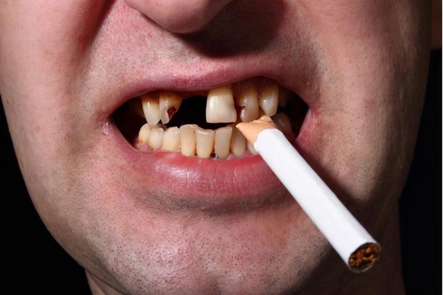 抽烟的人牙石量普遍高于常人,烟雾中的化学成分会对牙周组织造成慢性