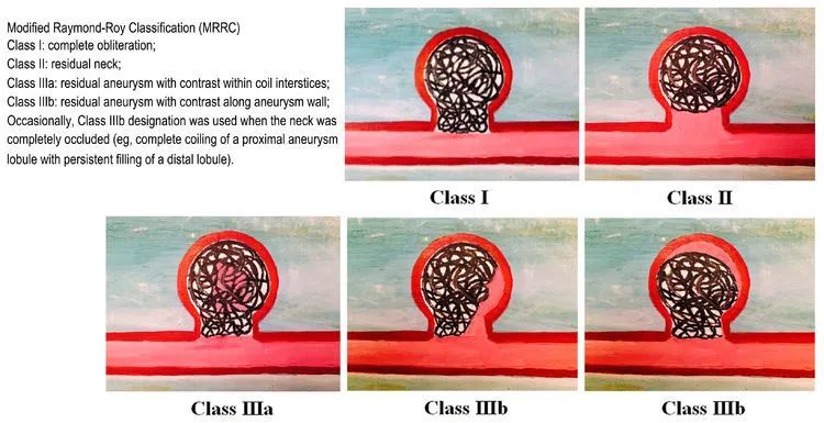 弹簧圈的选择 第二十五回复发性动脉瘤问答 腾讯新闻