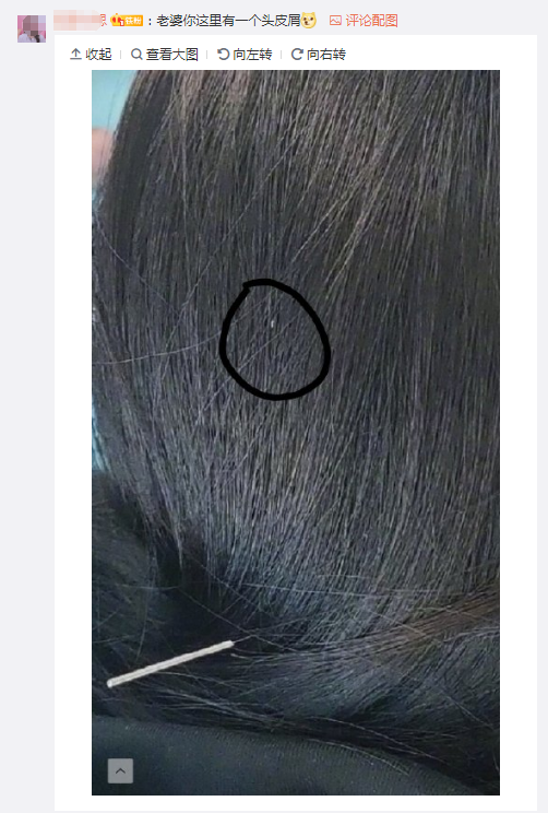 就有粉丝专门放大杨幂针灸的照片,并用黑圈圈出了杨幂头上的头皮屑