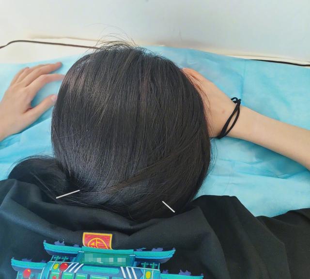 杨幂|34岁杨幂身体抱恙，趴病床头部被扎六根针，自侃：人被针扎傻了