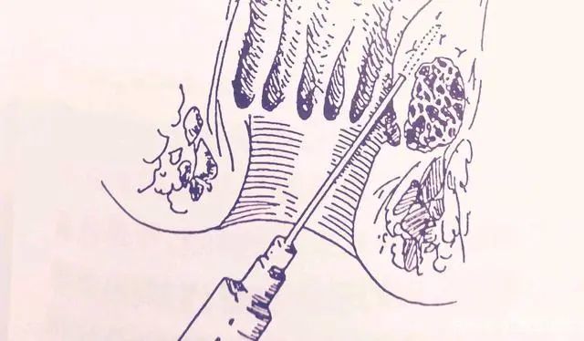 杏林微科普痔疮手术到底要不要做