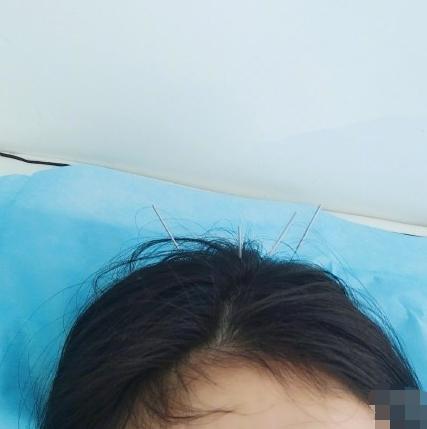 杨幂|杨幂晒针灸治疗照片，用碎发遮挡发际线？未见绯闻男友魏大勋关心