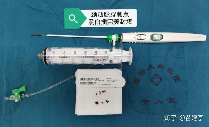 脑卒中|西安大兴医院脑科医院卒中团队：突破高龄禁区，急诊动脉取栓，再创生命奇迹