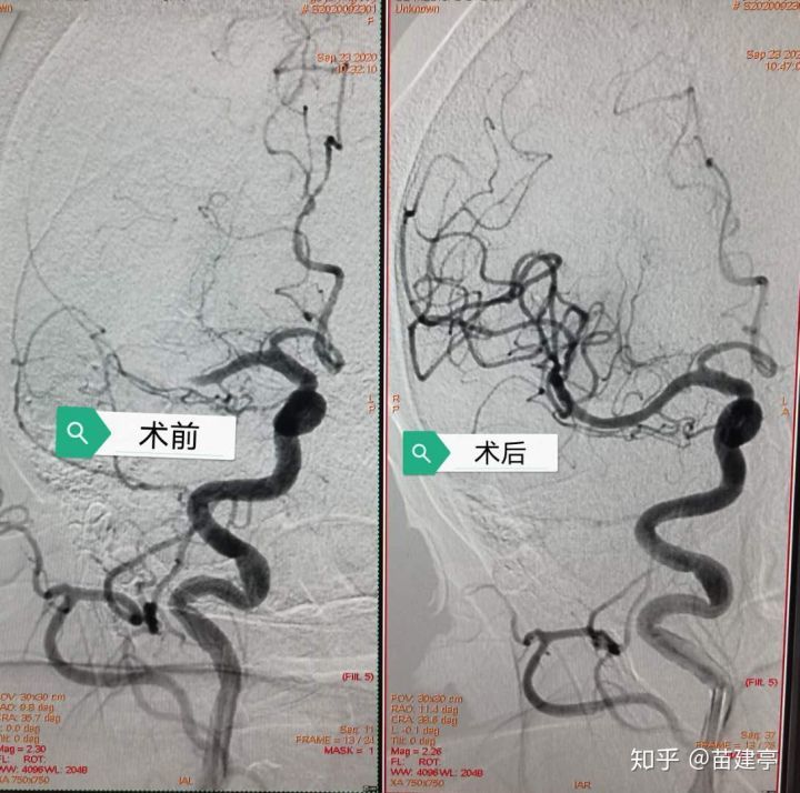 脑卒中|西安大兴医院脑科医院卒中团队：突破高龄禁区，急诊动脉取栓，再创生命奇迹