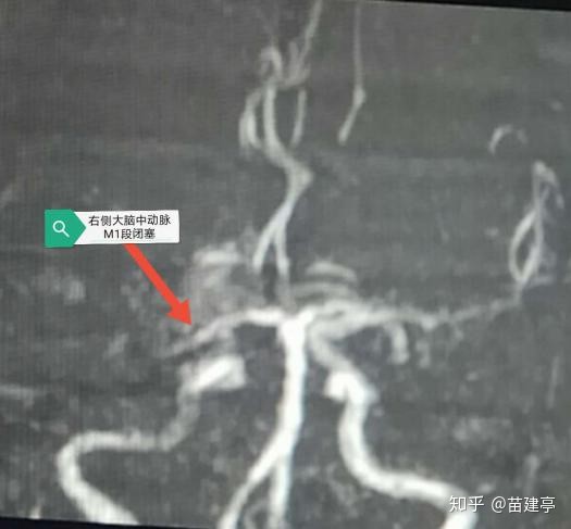 脑卒中|西安大兴医院脑科医院卒中团队：突破高龄禁区，急诊动脉取栓，再创生命奇迹