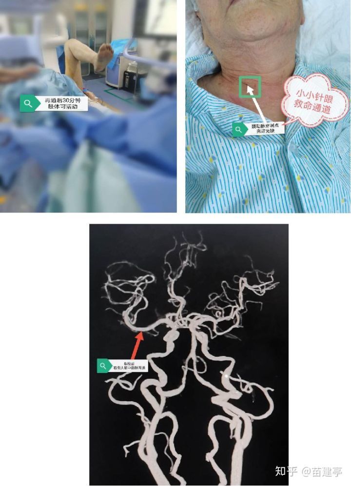 脑卒中|西安大兴医院脑科医院卒中团队：突破高龄禁区，急诊动脉取栓，再创生命奇迹