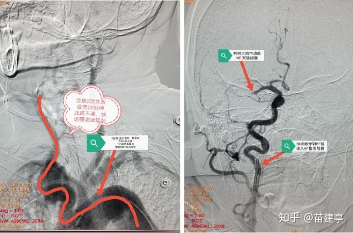 脑卒中|西安大兴医院脑科医院卒中团队：突破高龄禁区，急诊动脉取栓，再创生命奇迹