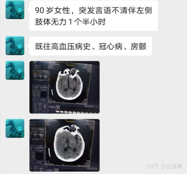 脑卒中|西安大兴医院脑科医院卒中团队：突破高龄禁区，急诊动脉取栓，再创生命奇迹