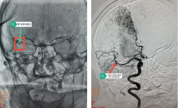 脑卒中|西安大兴医院脑科医院卒中团队：突破高龄禁区，急诊动脉取栓，再创生命奇迹