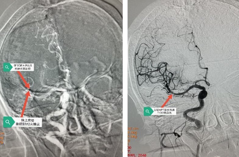 脑卒中|西安大兴医院脑科医院卒中团队：突破高龄禁区，急诊动脉取栓，再创生命奇迹