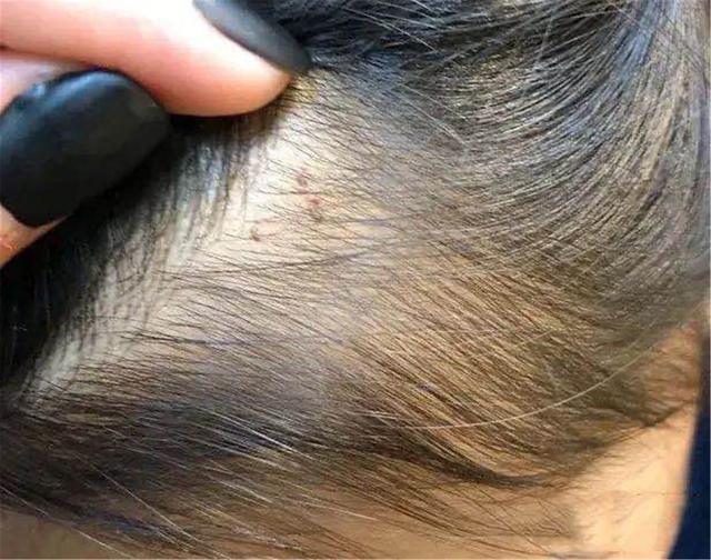 女儿的臀部有3个显眼的针眼,经过询问孩子才说是被幼儿园某个老师扎的