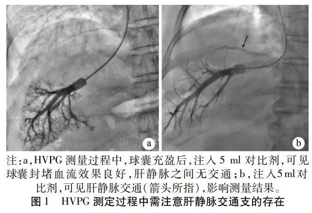 王宇：肝静脉压力梯度对肝硬化临床终点事件的预测_腾讯新闻