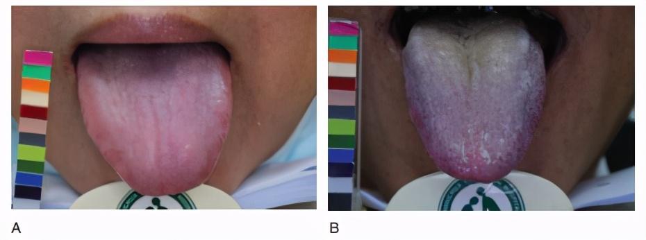 糖尿病患者的舌苔图片图片