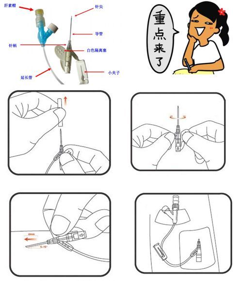 留置针 您需要注意的那点事 腾讯新闻