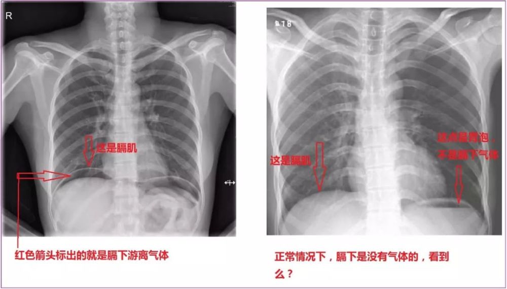 所以腹腔内会有气体,气体是往上走的,所以会积聚在患者膈肌下方,这