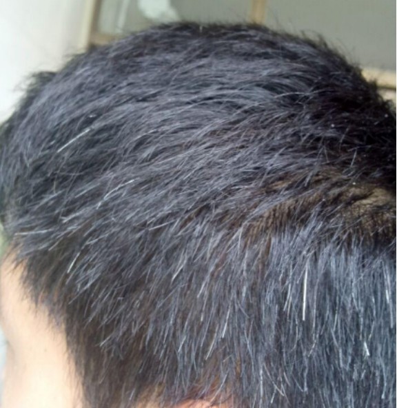 有什么办法可以补救白头发吗?