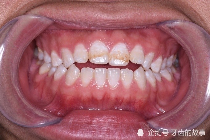 牙齿变黄颜色不好看难道就一直这样下去吗