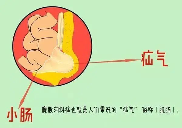 小儿疝气危害大泌尿外科解忧愁