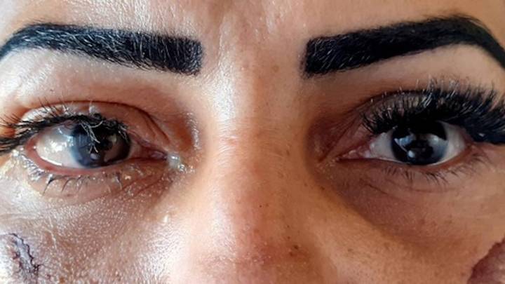 巴西女子贴假睫毛时,胶水不慎滴入眼睛致其失明