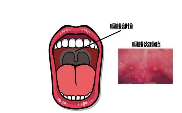 疱疹性咽峡炎很头疼我们一起解决它