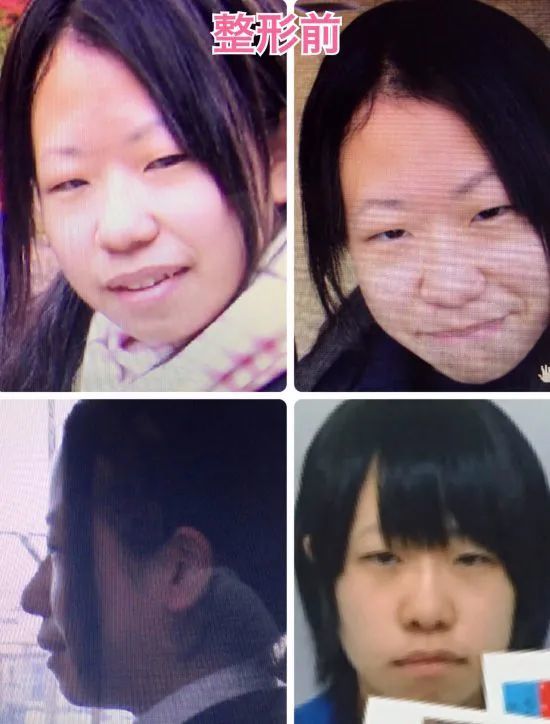mikishi|日本妹纸因长相被霸凌怒而整形！是换头术没错了……