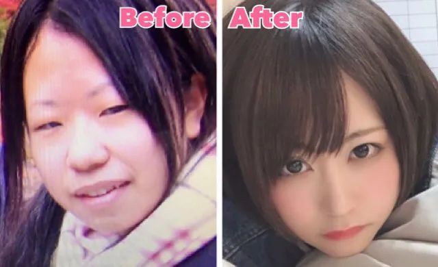 mikishi|日本妹纸因长相被霸凌怒而整形！是换头术没错了……