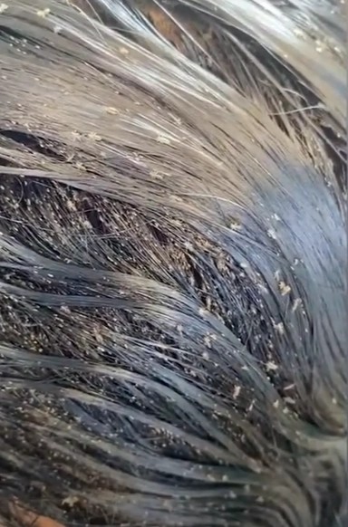 美国女子满头爬满虱子,密密麻麻,场景令人作呕_腾讯新闻