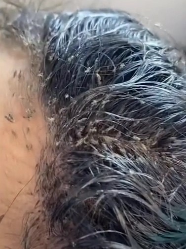 在德克萨斯州的一家专科诊所里,成群的虱子在这名女子的头上蠕动