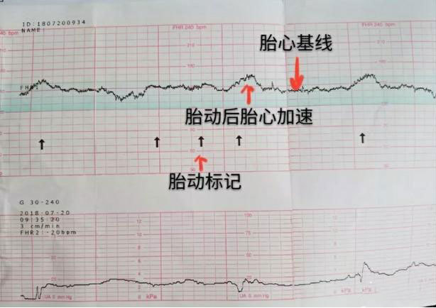胎心监护看胎儿是否缺氧一周一次有必要吗做好4点胎监一次过
