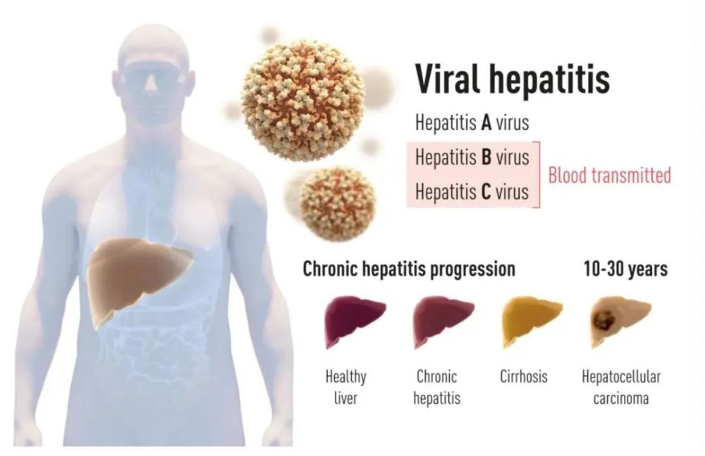 丙型肝炎病毒|至今也没有疫苗的丙型肝炎病毒，为什么还能斩获2020年诺奖？