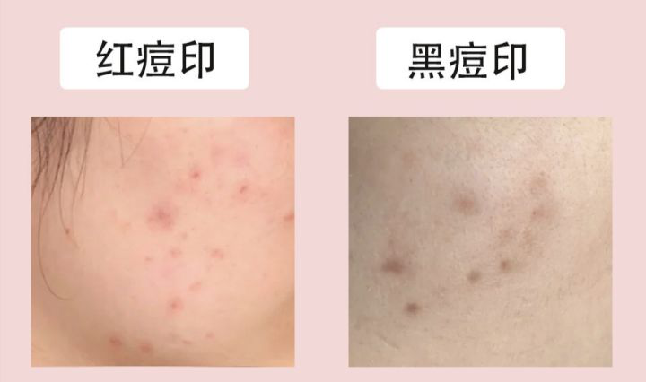 你知道万恶的痘印怎么祛除吗?