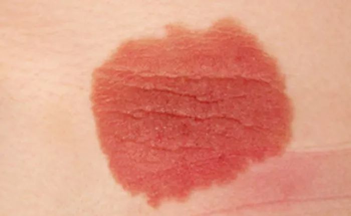 宝宝的胎记真不用管吗?错!如果长这样,一定要看医生!_腾讯新闻