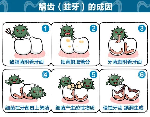 长时间侵蚀牙齿就会形成龋齿