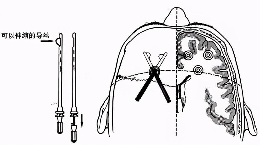 诺贝尔|这位医生发明这项手术，获得诺贝尔生物学或医学奖，也毁了上万人