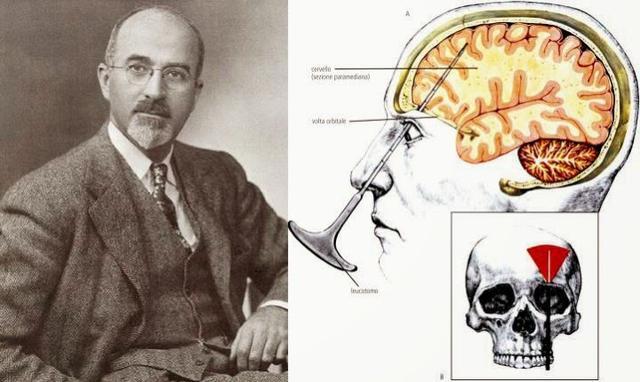 诺贝尔|这位医生发明这项手术，获得诺贝尔生物学或医学奖，也毁了上万人