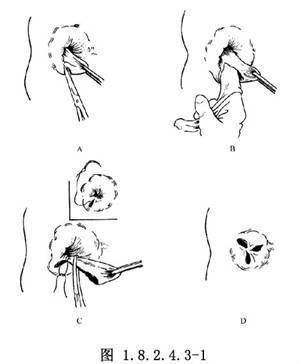 十人九痔十痔九不治医生告诉你如何正确的治疗痔疮