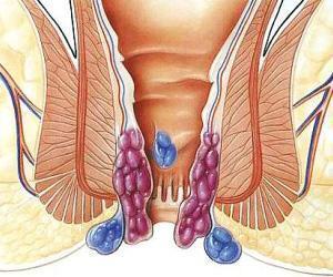 痔疮|十人九痔，十痔九不治？医生告诉你如何正确的治疗痔疮