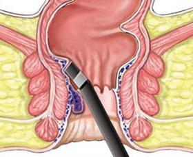 痔疮|十人九痔，十痔九不治？医生告诉你如何正确的治疗痔疮