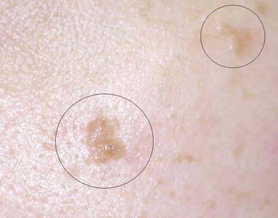 你知道吗?有些"疙瘩"不是皮肤毛病,而是hpv在"捣乱",早重视