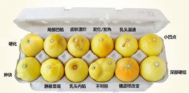 早期乳腺癌的几个重要信号,知道早能救命