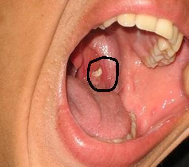 喉咙老是感觉东西 刷牙依然口臭 可能是它造成的 扁桃腺结石 口腔异味 咽喉 扁桃体结石