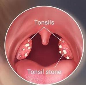 喉咙老是感觉东西 刷牙依然口臭 可能是它造成的 扁桃腺结石 口腔异味 咽喉 扁桃体结石