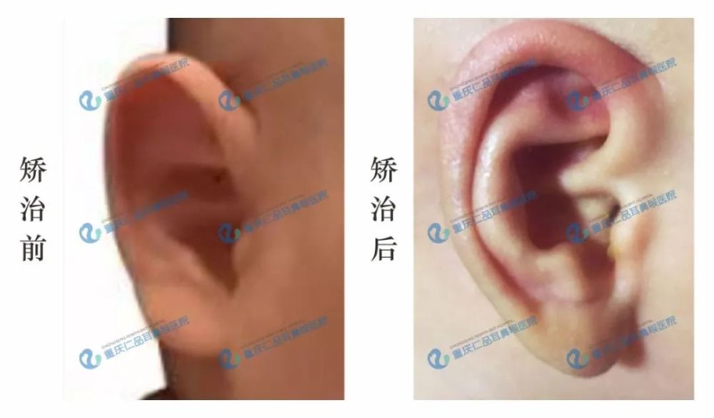 8种耳廓畸形矫治案例扫盲 腾讯新闻