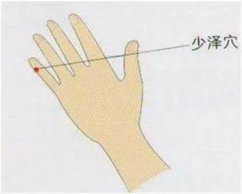 当平齐尺侧指甲与指腹尺侧缘之中点处,速刺放血, 患侧之少泽多出黑血