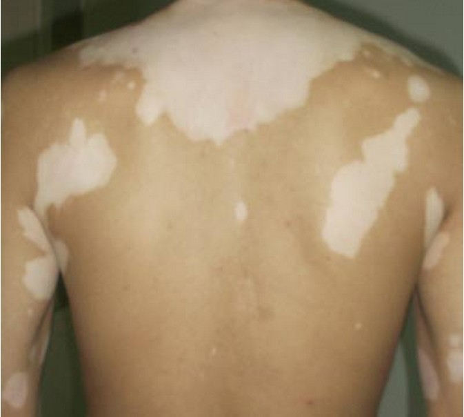 苍耳子|1种常见的小灌木，可治疗各种风湿，更是顽固白癜风的克星？！