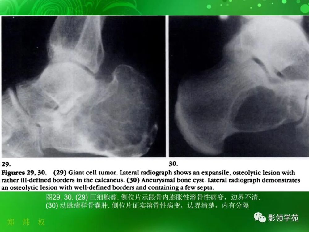 跟骨正常与变异影像学表现 腾讯新闻