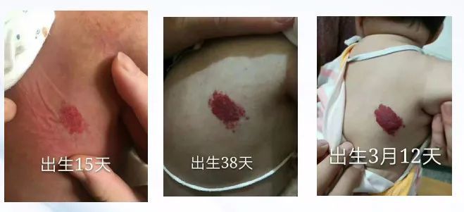 海绵状血管瘤|血管瘤发展期是什么时候？要从这几种情况来看