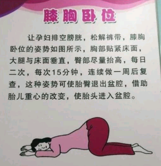 孕妇膝胸卧位置示意图图片